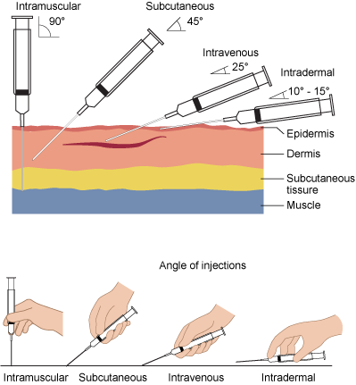 Illustration showing angles of insertion for needle injections