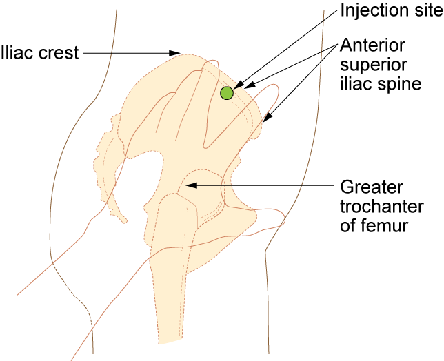 Ilustración que muestra cómo localizar el sitio ventroglúteo