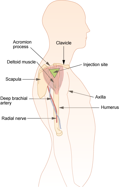 Ilustración que muestra cómo localizar el sitio de inyección de deltoides