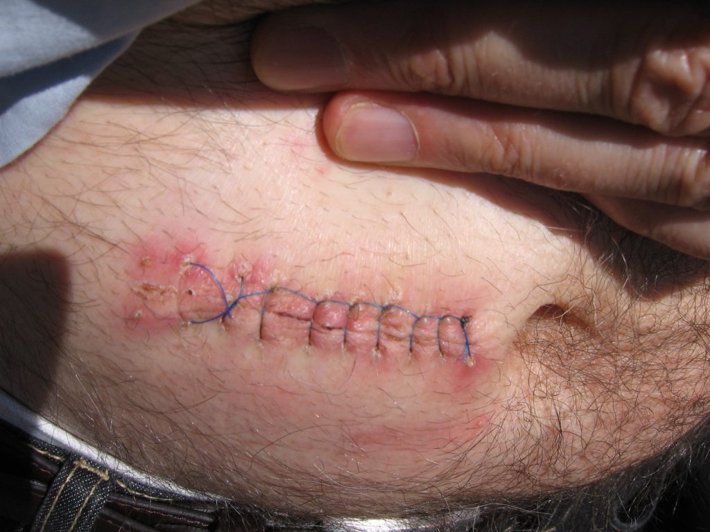 Photo closeup of stiches healing on a person's stomach
