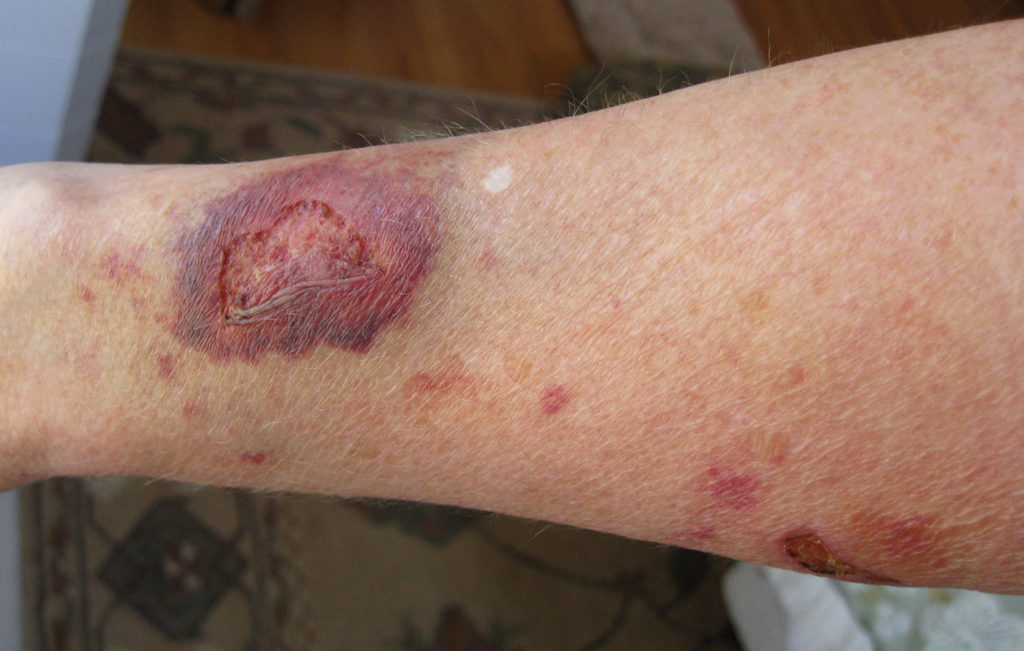 Photo showing a wound on the forearm healing by secondary intention