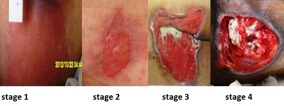 Photo showing four stages of pressure wounds