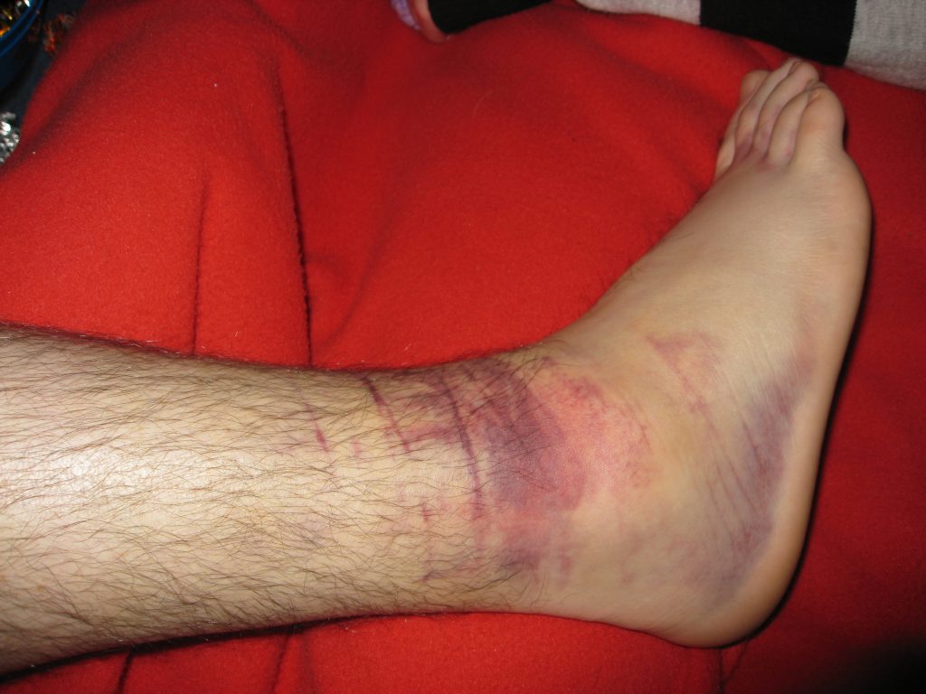Photo showing hematoma on ankle and foot of person