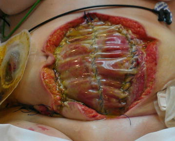 Photo showing dehiscence on abdominal wound