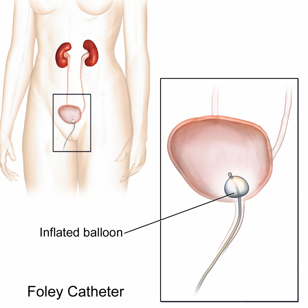 Ilustración que muestra la colocación del catéter Foley en vejiga