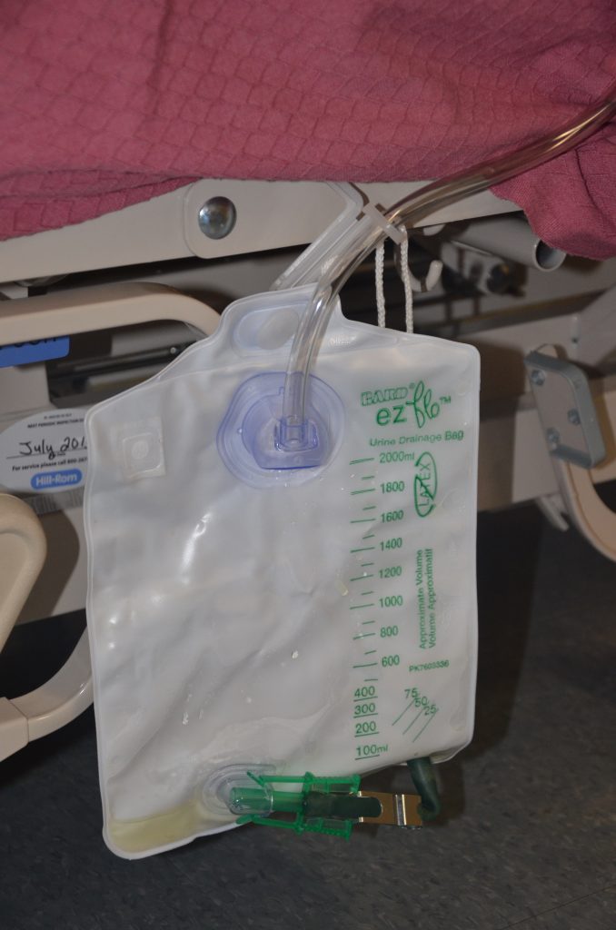 Photo showing a urine collection bag