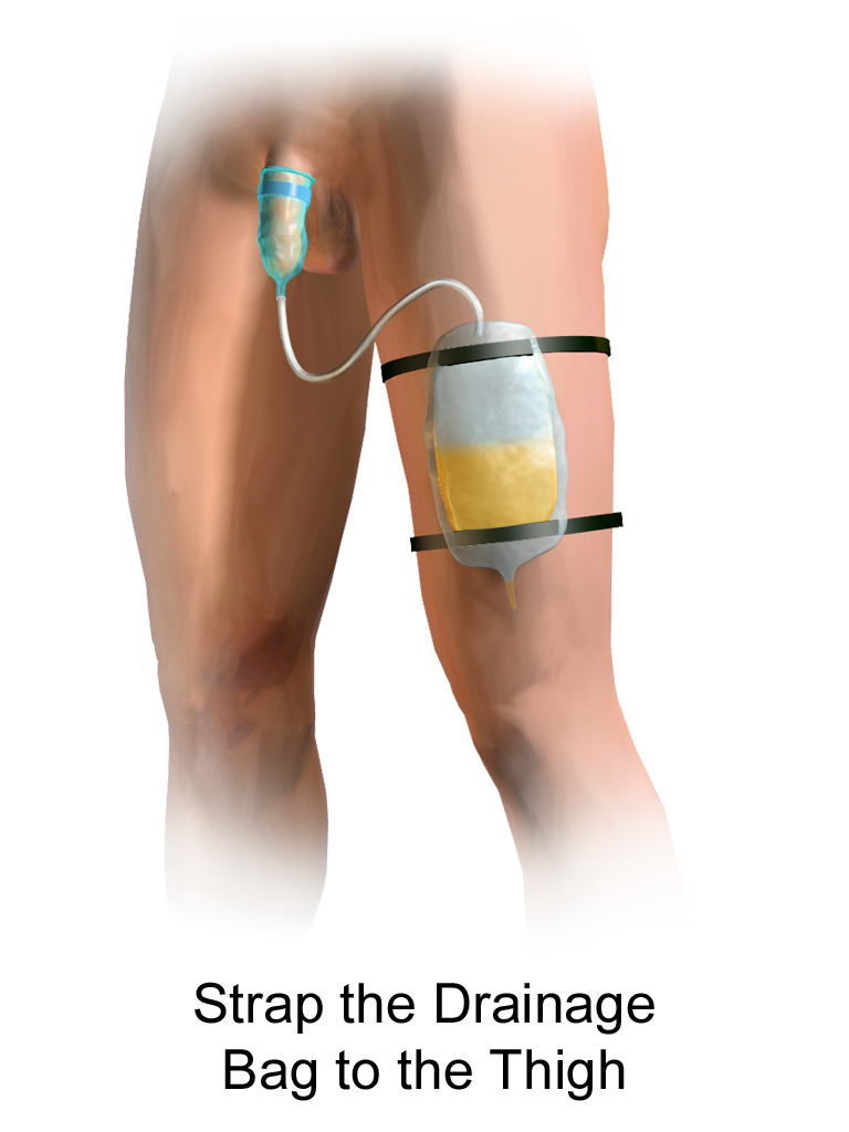 Ilustración que muestra catéter de condón unido a bolsa de pierna en paciente masculino
