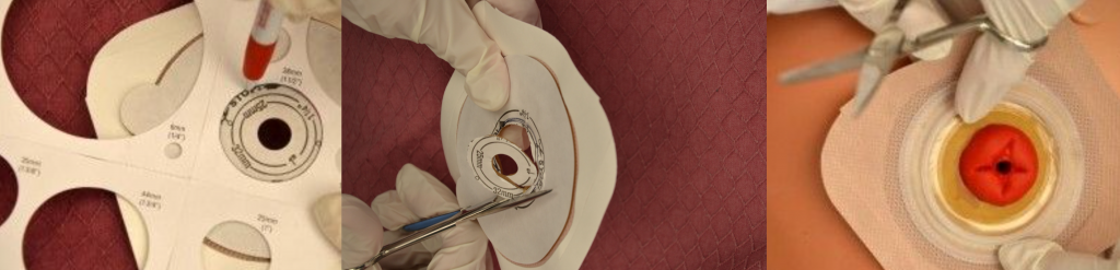 Photos showing three of the steps in fitting a barrier to a stoma
