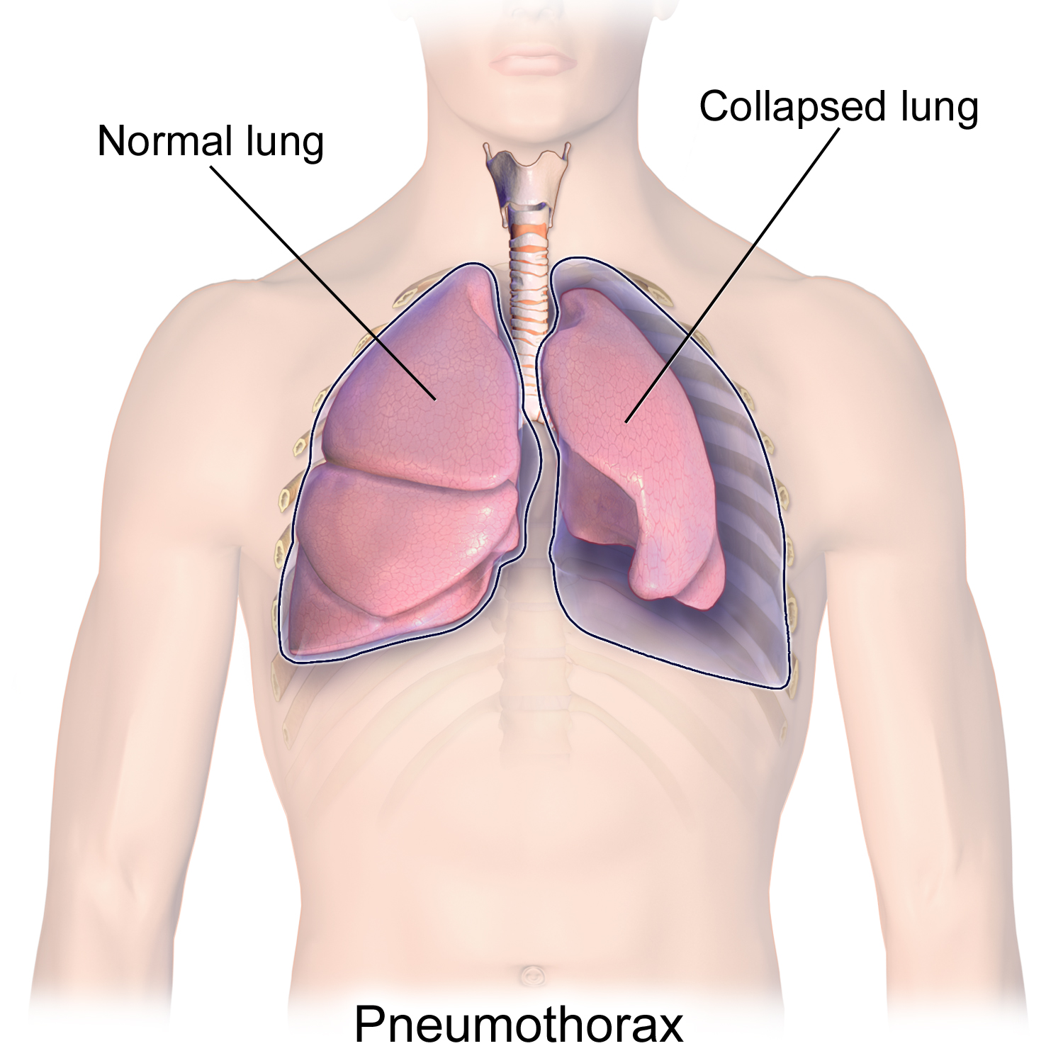 Pneumothorax on the left, as indicated by air in the pleural cavity and collapse of the left lung.