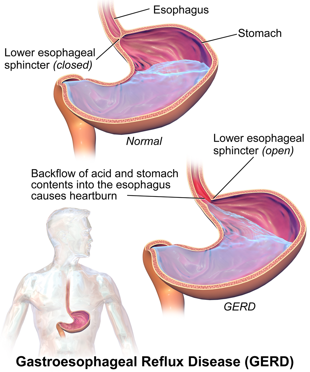 Image comparing normal functioning of lower esophageal sphincter in a closed position to keep stomach contents in stomach vs. open sphincter in Gastroesophageal Reflux Disease that allows backflow of acid and stomach contents into the esophagus leading to heartburn.