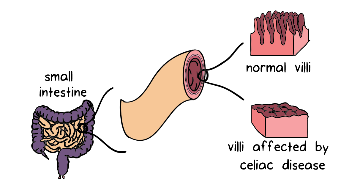 Image comparing normal villi projecting out from the intestinal wall vs. flattened villi affected by celiac disease.