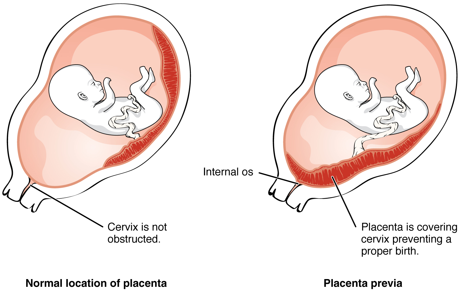 El panel izquierdo de esta imagen muestra la ubicación normal de la placenta y el panel derecho muestra la ubicación de la placenta en placenta previa.