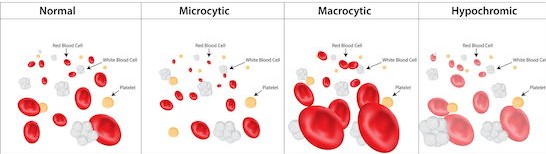 Normal red blood cells compared to microcytic cells that are smaller in size and macrocytic cells that are larger in size.