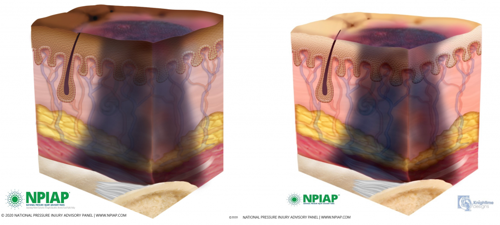 Image showing deep tissue pressure injury on both dark and light pigmented skin
