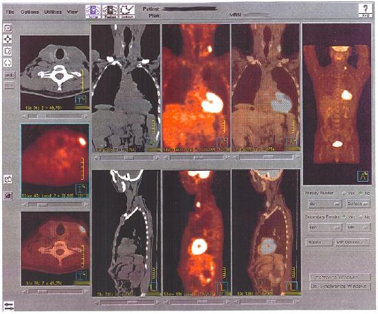 PET scans of tumors.