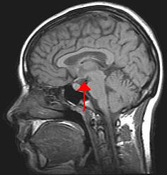 Image showing an arrow pointing to the hypothalamus in the brain