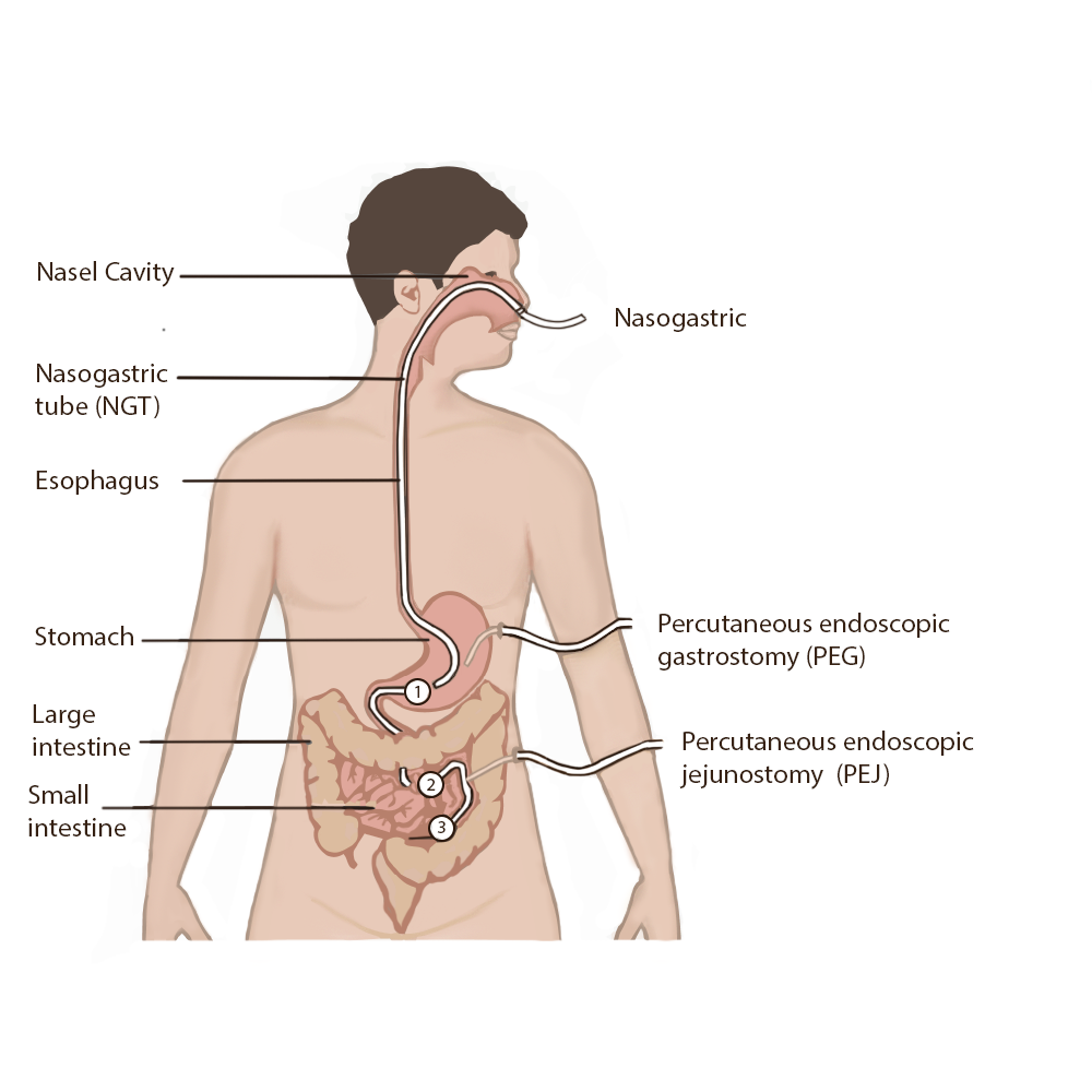 Image showing types and placement of enteral tubes, with text labels