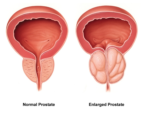 Image showing a normal and an enlarged prostate gland