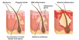 Las tres etapas del acné taponaron el folículo, inflamación leve y marcada inflamación
