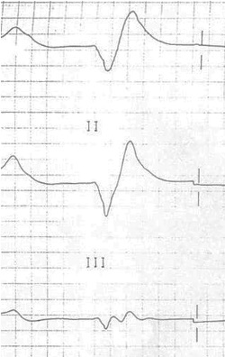 The ECG associated with severe hyperkalemia has leads 1-3 shown. The QRS is very broad and almost sine-wave like with a slow descending negative component that rises up to become a slow ascending wave before returning to baseline. 