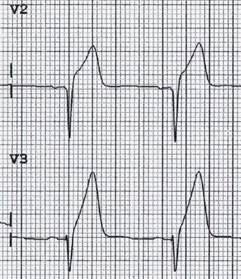 Lead V2 and V3 ECGs show a downward orientation QRS complex followed by an abnormally large, positive T-wave.