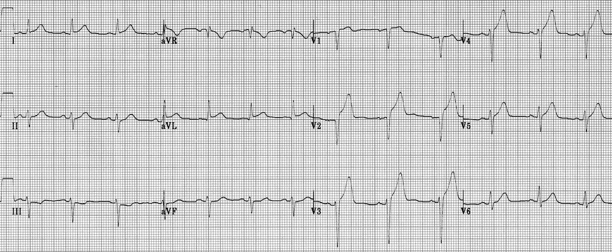All leads of a 12-lead ECG are shown to illustrate the consequences of an anterior wall MI. ST-segment elevation and a J-point are seen in leads V2, V3, and V4 and the T-wave is broad and prominent in these leads to take on a tombstone appearance. 