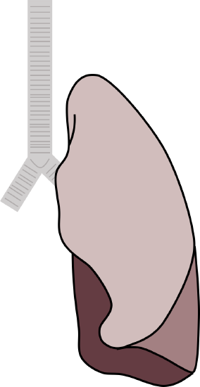 a cartoon of a lung with the lower lobe in a solid dark color (denoting infection and inflammation throughout the lobe)