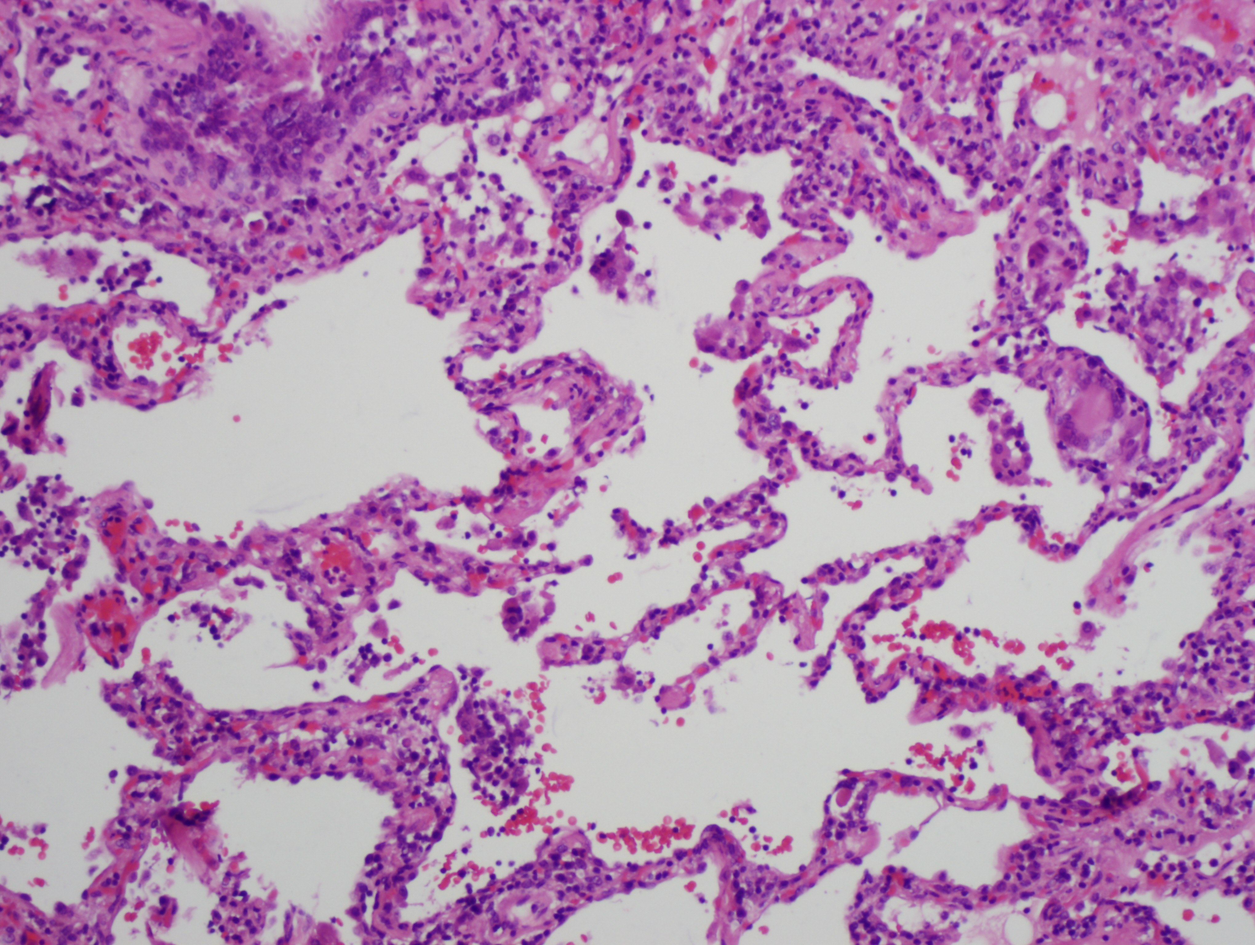 A histological slide of lung tissue shows open air spaces but there is severe thickening of the alveolar septum.