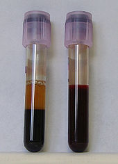 Dos tubos de sangre anticoagulada con EDTA. Tubo izquierdo: después de estar de pie, los RBC se han asentado en la parte inferior del tubo.
