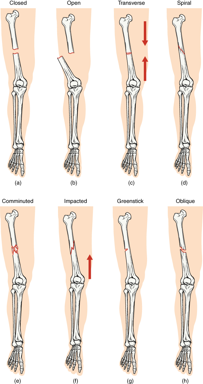 In this illustration, each type of fracture is shown on the right femur from an anterior view. In the closed fracture, the femur is broken in the middle of the shaft with the upper and lower halves of the bone completely separated. However, the two halves of the bones are still aligned in that the broken edges are still facing each other. In an open fracture, the femur is broken in the middle of the shaft with the upper and lower halves of the bone completely separated. Unlike the closed fracture, in the open fracture, the two bone halves are misaligned. The lower half is turned laterally and it has protruded through the skin of the thigh. The broken ends no longer line up with each other. In a transverse fracture, the bone has a crack entirely through its width, however, the broken ends are not separated. The crack is perpendicular to the long axis of the bone. Arrows indicate that this is usually caused by compression of the bone in a superior-inferior direction. A spiral fracture travels diagonally through the diameter of the bone. In a comminuted fracture, the bone has several connecting cracks at its middle. It is possible that the bone could splinter into several small pieces at the site of the comminuted fracture. In an impacted fracture, the crack zig zags throughout the width of the bone like a lightning bolt. An arrow indicates that these are usually caused by an impact that pushes the femur up into the body. A greenstick fracture is a small crack that does not extend through the entire width of the bone. The oblique fracture shown here is travelling diagonally through the shaft of the femur at about a thirty degree angle