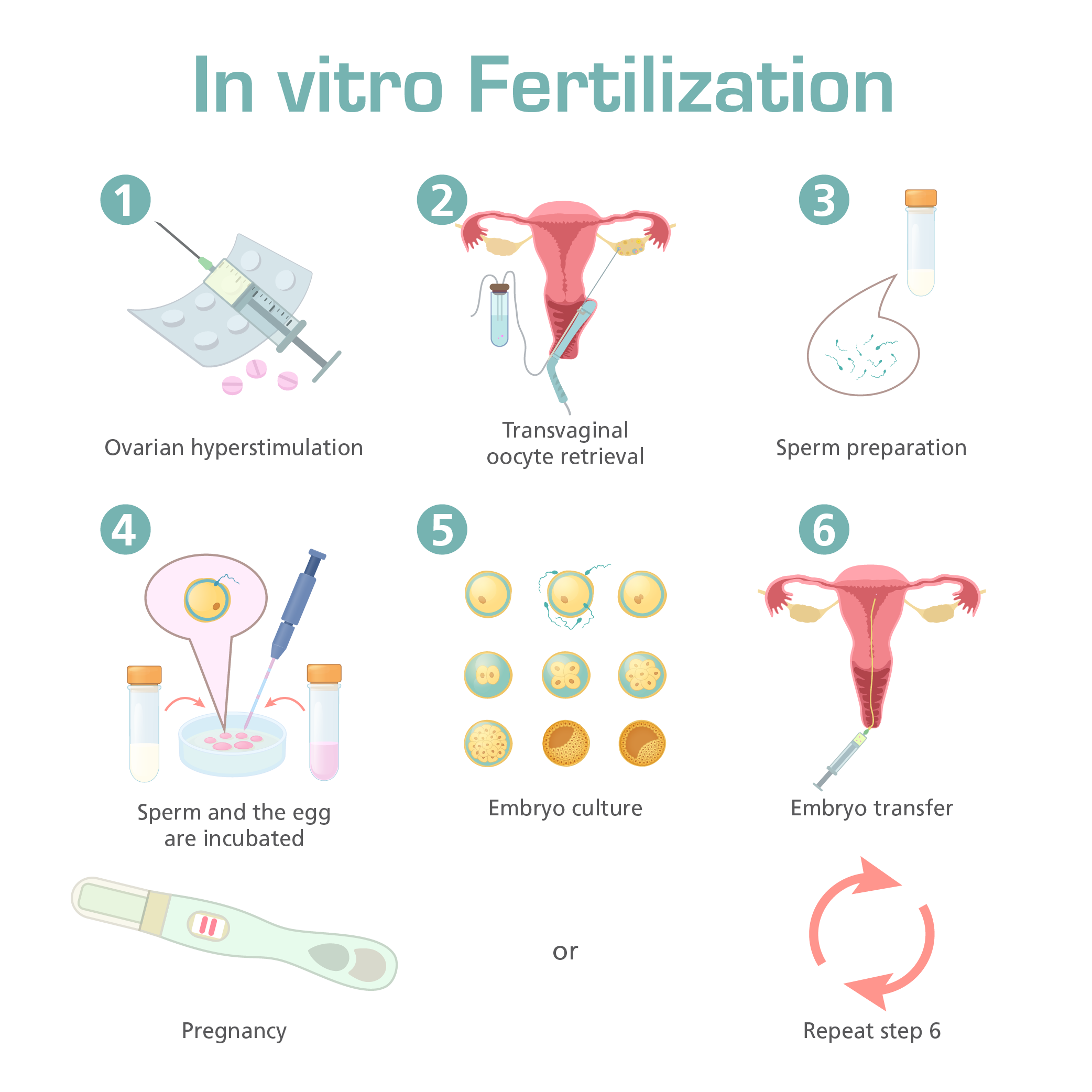 This multi-part figure shows the different steps in in vitro fertilization. The top panel shows how the oocytes and the sperm are collected and prepared (text reads: 1) Ovarian hyperstimulation, 2) Transvaginal oocyte retrieval, 3)Sperm preparation, 4) Sperm and the egg are incubated, 5) Embryo culture, 6) Embryo transfer, then the last panel shows either pregnancy or the process is repeated.