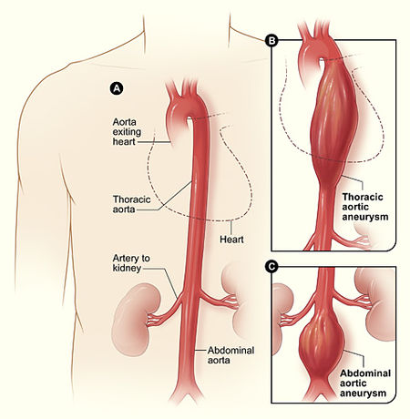 Este diagrama muestra las arterias en la cavidad torácica y abdominal. Ramas viscerales de las etiquetas de aorta torácica (desde arriba): bronquial, esofágico, mediastínico, pericárdico, aorta torácica, hiato aórtico, tronco celíaco, gástrico izquierdo, esplénico, hepático común, mesentérico superior, aorta abdominal, mesentérico inferior, ilíaco externo. Ramas parietales (somáticas) de las etiquetas de aorta torácica (desde arriba): intercostales, frénicas superiores, frénicas inferiores, diafragmáticas, suprarrenales, renales, gonadales, lumbares, sacras medial, ilíacas comunes, ilíacas internas.