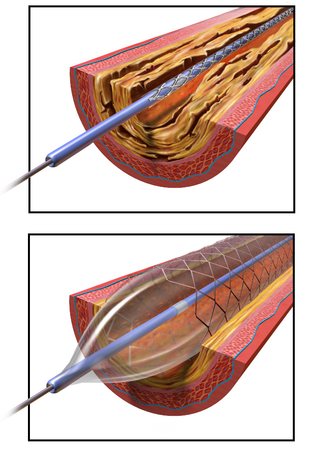 Angioplasty-Balloon Inflated with Stent
