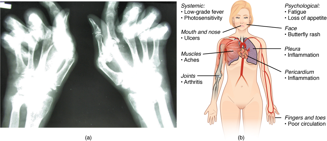 The left panel of this figure shows an x-ray image of a person’s hand with rheumatoid arthritis, and the right panel of this figure shows a woman’s body with labels showing the different responses in the body when the patient suffers from lupus. Labels (from top, clockwise) read: psychological: fatigue, loss of appetite, face butterfly rash, pleura inflammation, pericardium inflammation, fingers and toes poor circulation, joints arthritis, muscles aches, mouth and nose ulcers, systemic: low-grade fever photosensitivity.