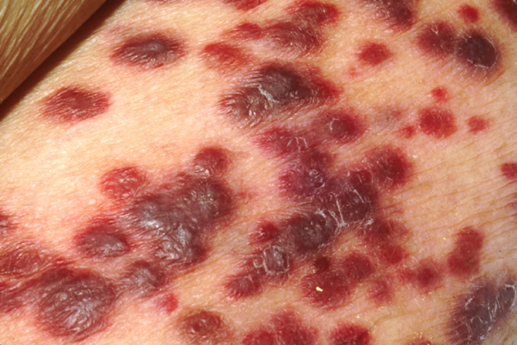 This photograph shows lesions on the surface of skin which are characteristic of Kaposi's sarcoma.