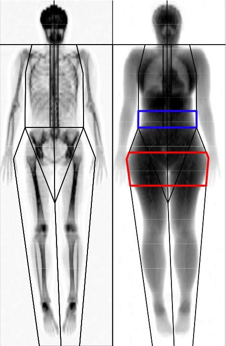 Typical-full-body-DXA-scan-The-android-region-of-interest-ROI-is-highlighted-in-blue.png