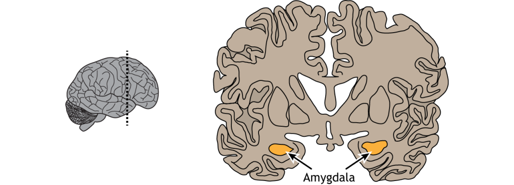 Ilustración de una sección coronal del cerebro que muestra la ubicación de la amígdala en el lóbulo temporal.