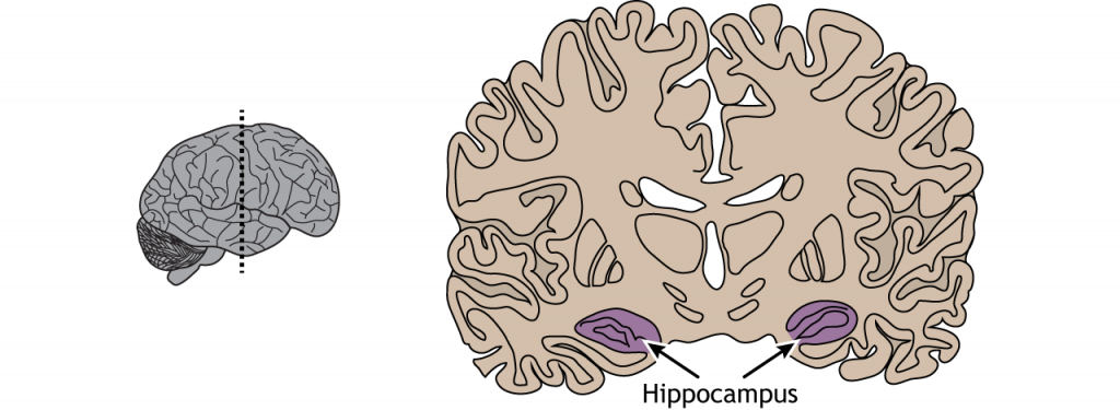 Ilustración de una sección coronal del cerebro que muestra la ubicación del hipocampo en el lóbulo temporal.