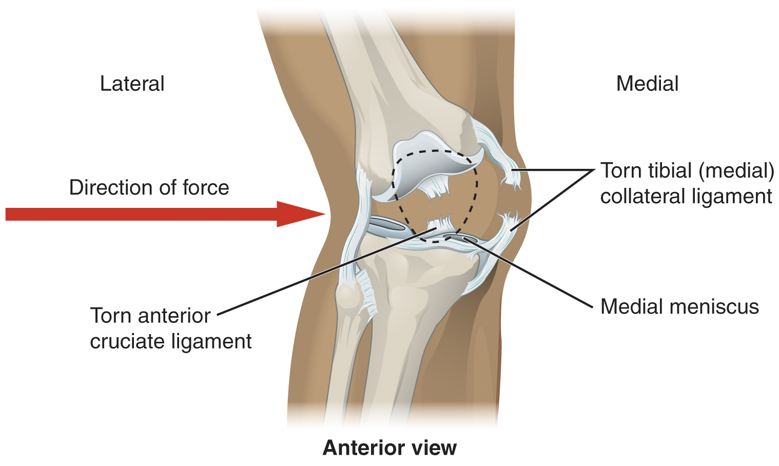 Esta imagem mostra uma articulação do joelho lesionada. Uma seta vermelha aponta da esquerda para a direita mostrando a direção da força que causou a lesão.