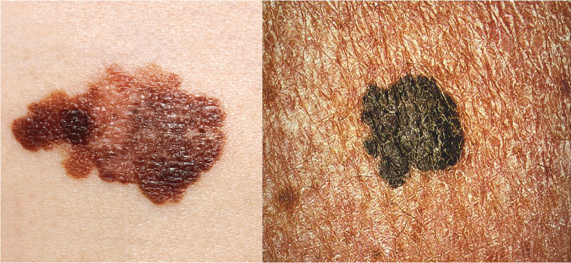 Esta foto mostra uma mancha de pele clara contendo um grande melanoma. O melanoma é preto e de aparência manchada.
