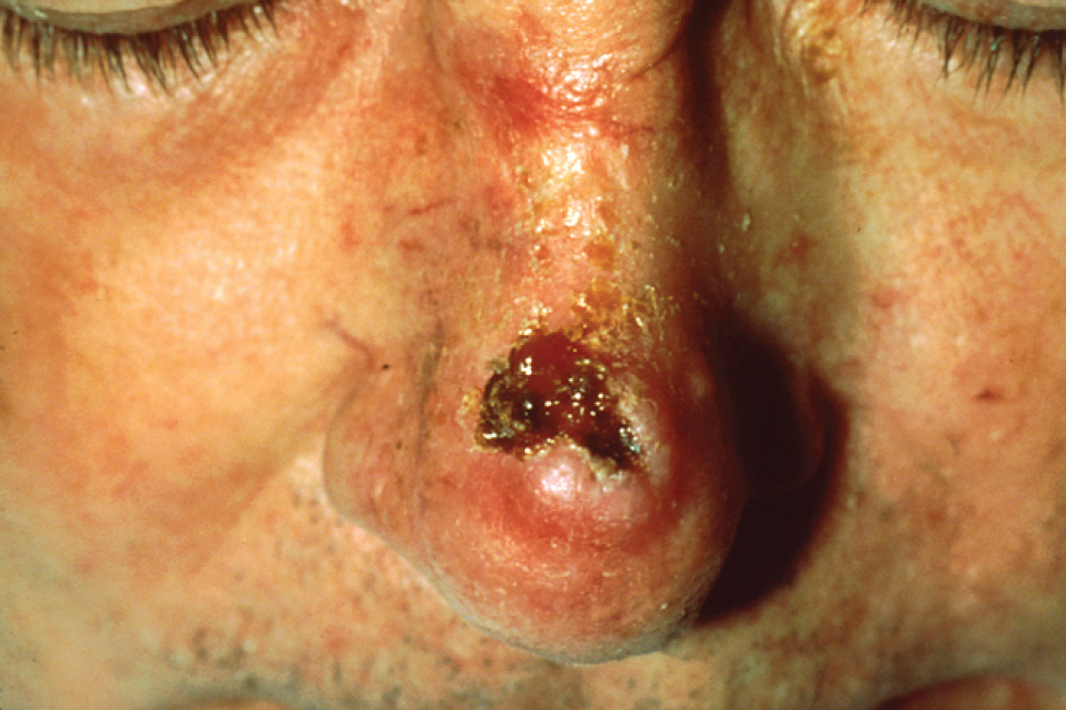 Esta foto mostra o nariz de um homem. O carcinoma de células escamosas está localizado logo acima da ponta do nariz e aparece como uma ferida vermelha profunda, de formato irregular, que abrange quase toda a ponte do nariz.