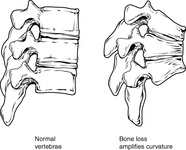 Esta figura mostra as alterações na coluna vertebral na osteoporose. O painel esquerdo mostra a estrutura das vértebras normais e o painel direito mostra as vértebras curvas na osteoporose.
