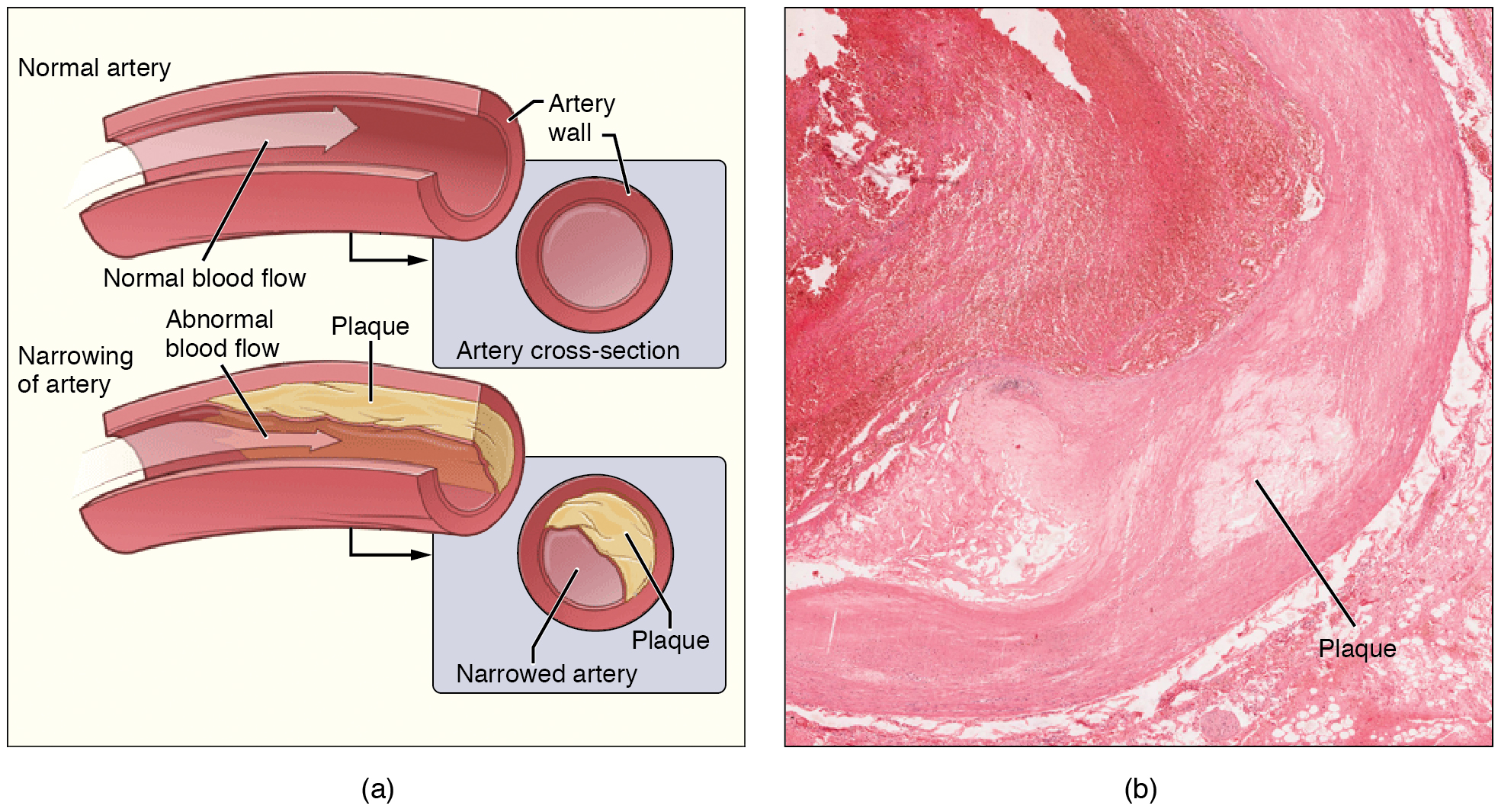 O painel esquerdo mostra a seção transversal de uma artéria normal e uma estreita. O painel direito mostra uma micrografia de uma artéria com placa.