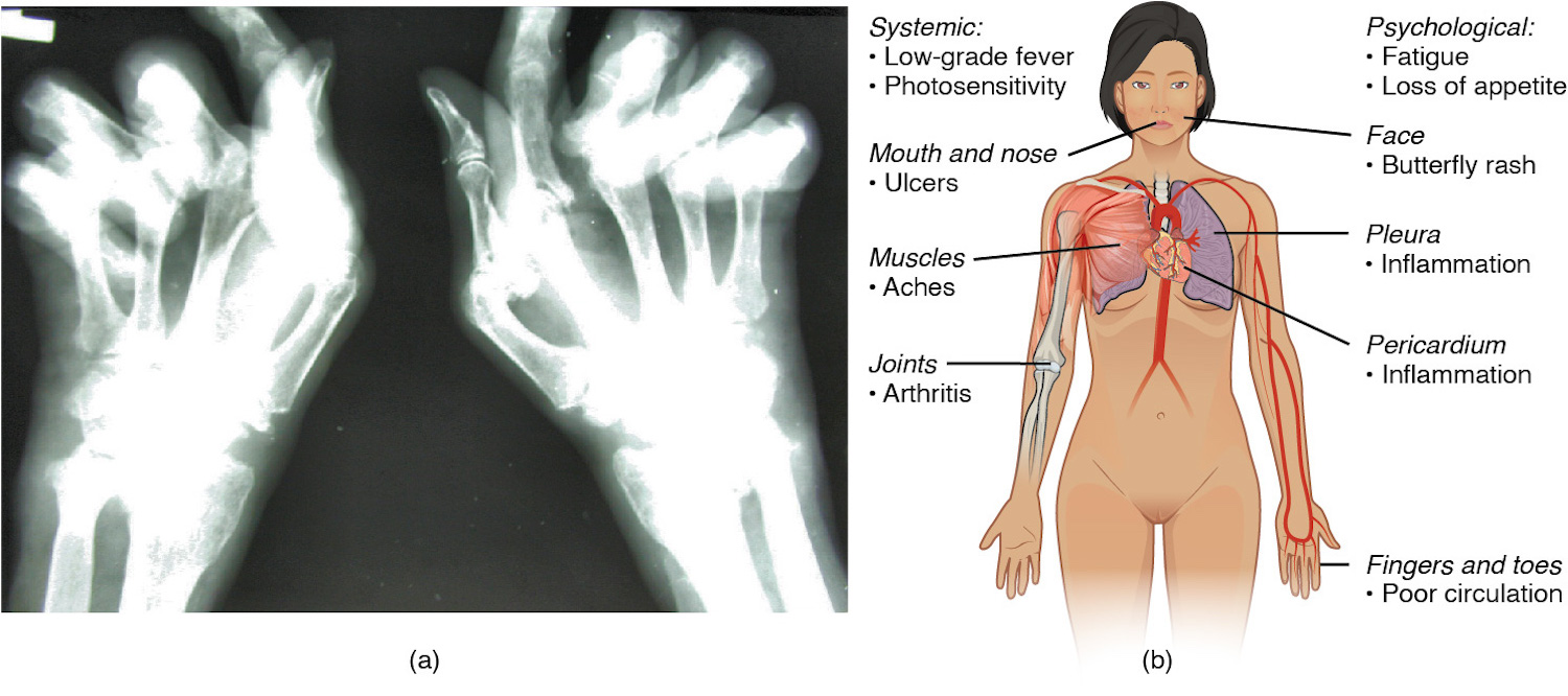 O painel esquerdo desta figura mostra uma imagem de raio-x da mão de uma pessoa com artrite reumatóide, e o painel direito desta figura mostra o corpo de uma mulher com rótulos mostrando as diferentes respostas do corpo quando o paciente sofre de lúpus.