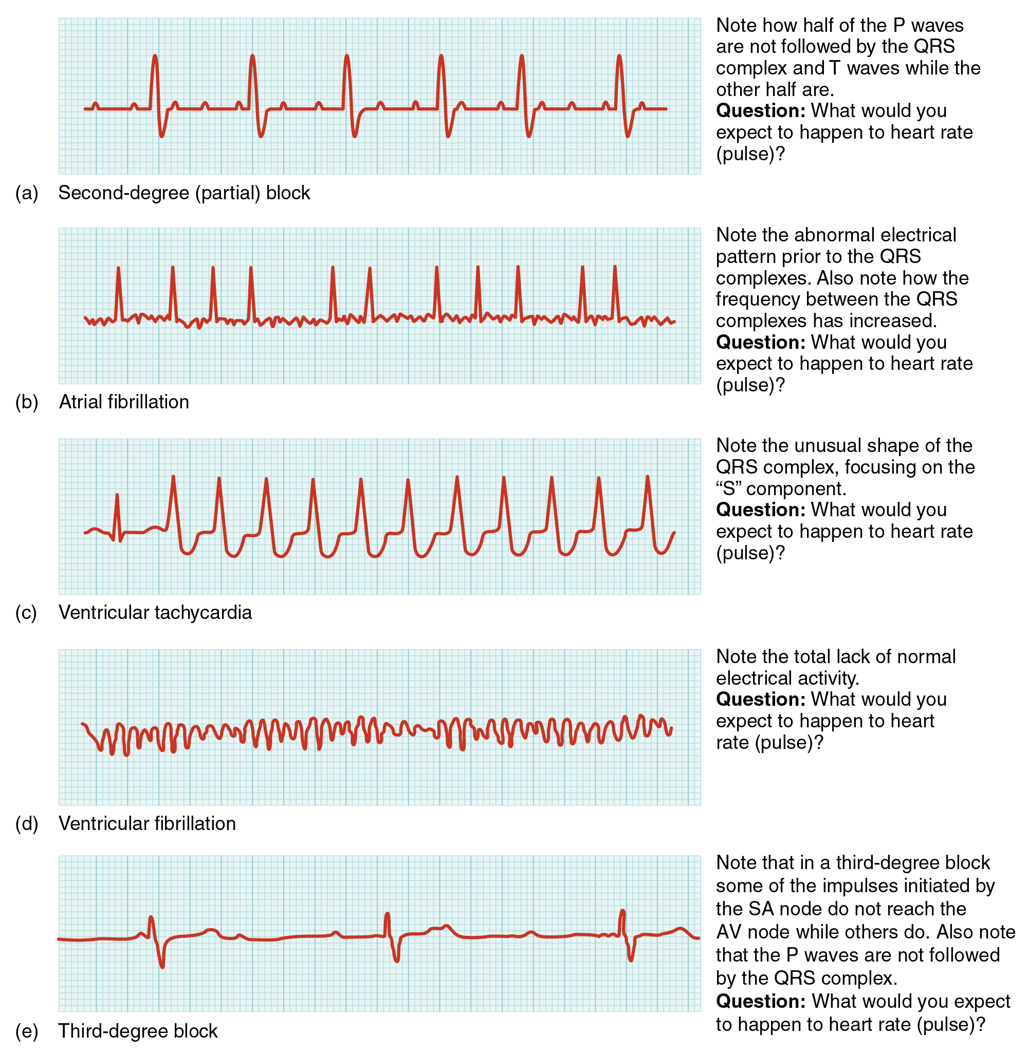 Nesta imagem é mostrado o ciclo QT para diferentes condições cardíacas. De cima para baixo, as arritmias apresentadas são bloqueio parcial de segundo grau, fibrilação atrial, taquicardia ventricular, fibrilação ventricular e bloqueio de terceiro grau.