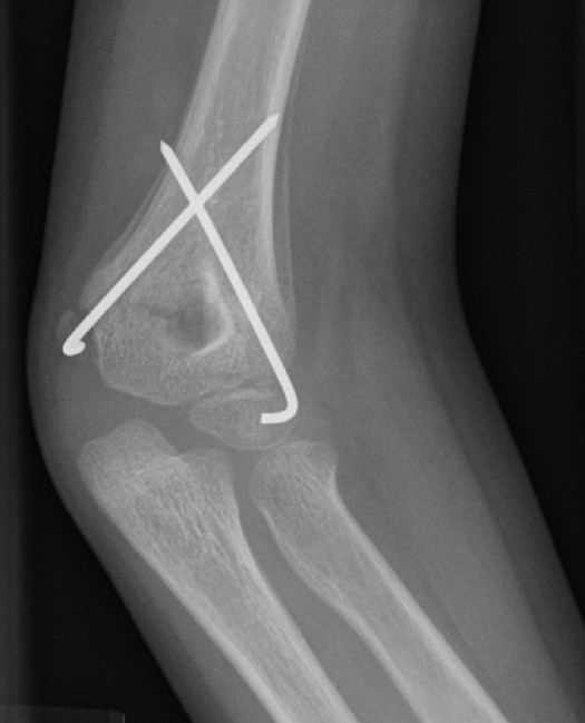 This is a radiographic image (x-ray) of a child's healing supracondylar humeral fracture that has been treated with closed reduction and pinning. This image, taken three weeks post injury, demonstrates the benign periosteal reaction of normal healing bone.