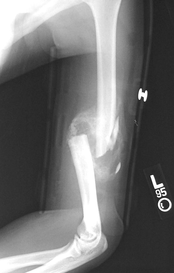 This is an x-ray image of a broken arm. It shows a communitive midshaft humeral fracture with callus formation.