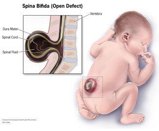 This is an illustration of a child with spina bifida. An open defect is seen at the base of the child's spine.