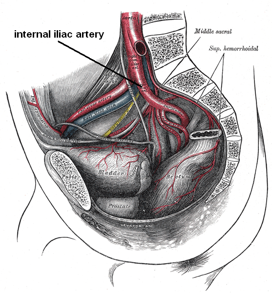 The division of the internal iliac artery into its posterior and anterior trunks.