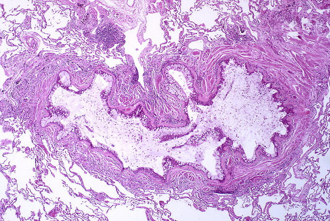 This is a cross-section of tissue affected by asthma. It shows obstruction of the lumen of the bronchiole by mucoid exudate, goblet cell metaplasia, epithelial basement membrane thickening, and severe inflammation of bronchiole.